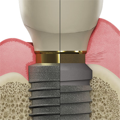 Laser-Lok comparé à un implant habituel