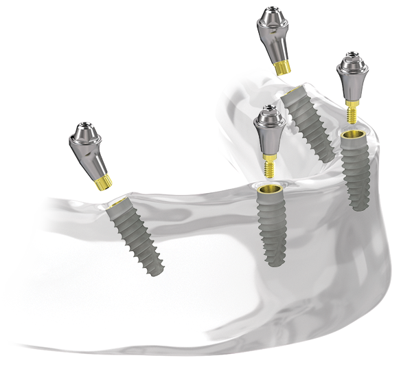 Tapered Pro Full-arch with TPC implants